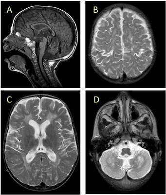 A novel missense mutation in ISCA2 causes aberrant splicing and leads to multiple mitochondrial dysfunctions syndrome 4